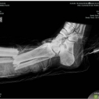 Zdjęcie rentgenowskie złamanej nogi Marcina Wasilewskiego