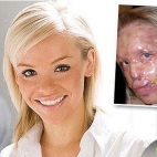 Katie Piper - przez dwadzieścia trzy godziny nosi na twarzy plastikową maskę medyczną