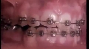 Niesamowite! 60 sekund jak aparat ortodontyczny prostuje zęby