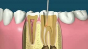Na czym polega leczenie kanołowe zęba :P